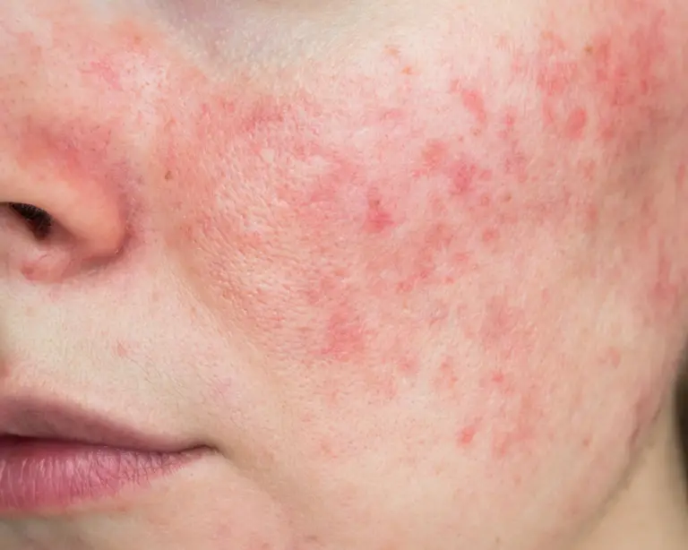 Tudo sobre Rosácea Como Tratar e Melhores Produtos Protocolo da Pele